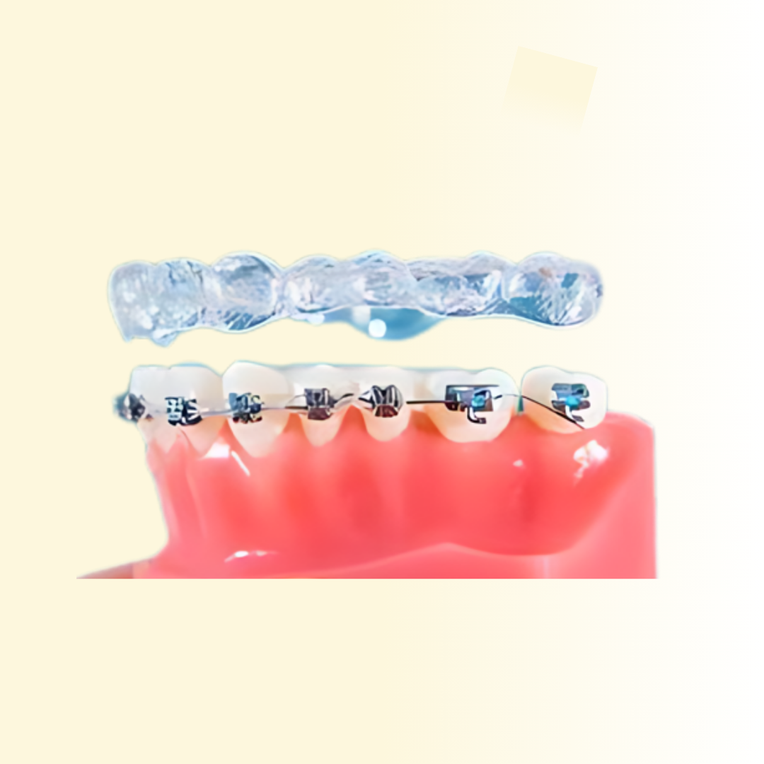 Braces & Aligners