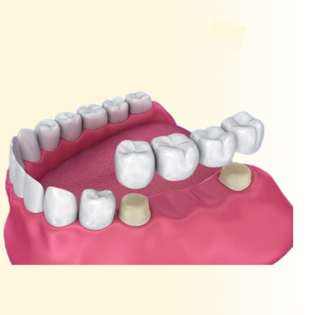 Dental Crowns & Bridges