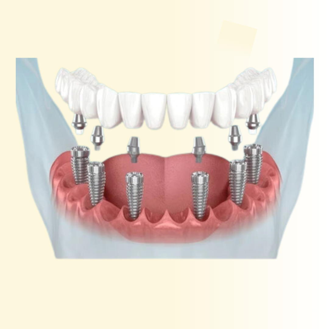 Dental Implants