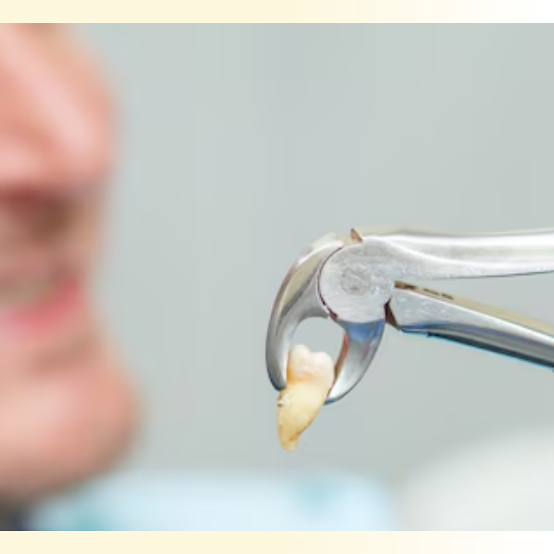 Tooth Extraction