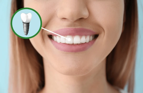 Advantages of Dental Implants