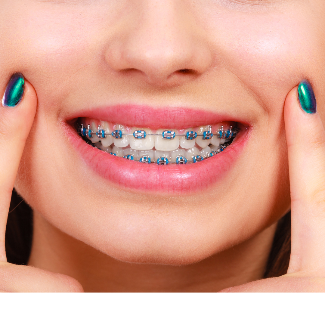 Braces & Aligner