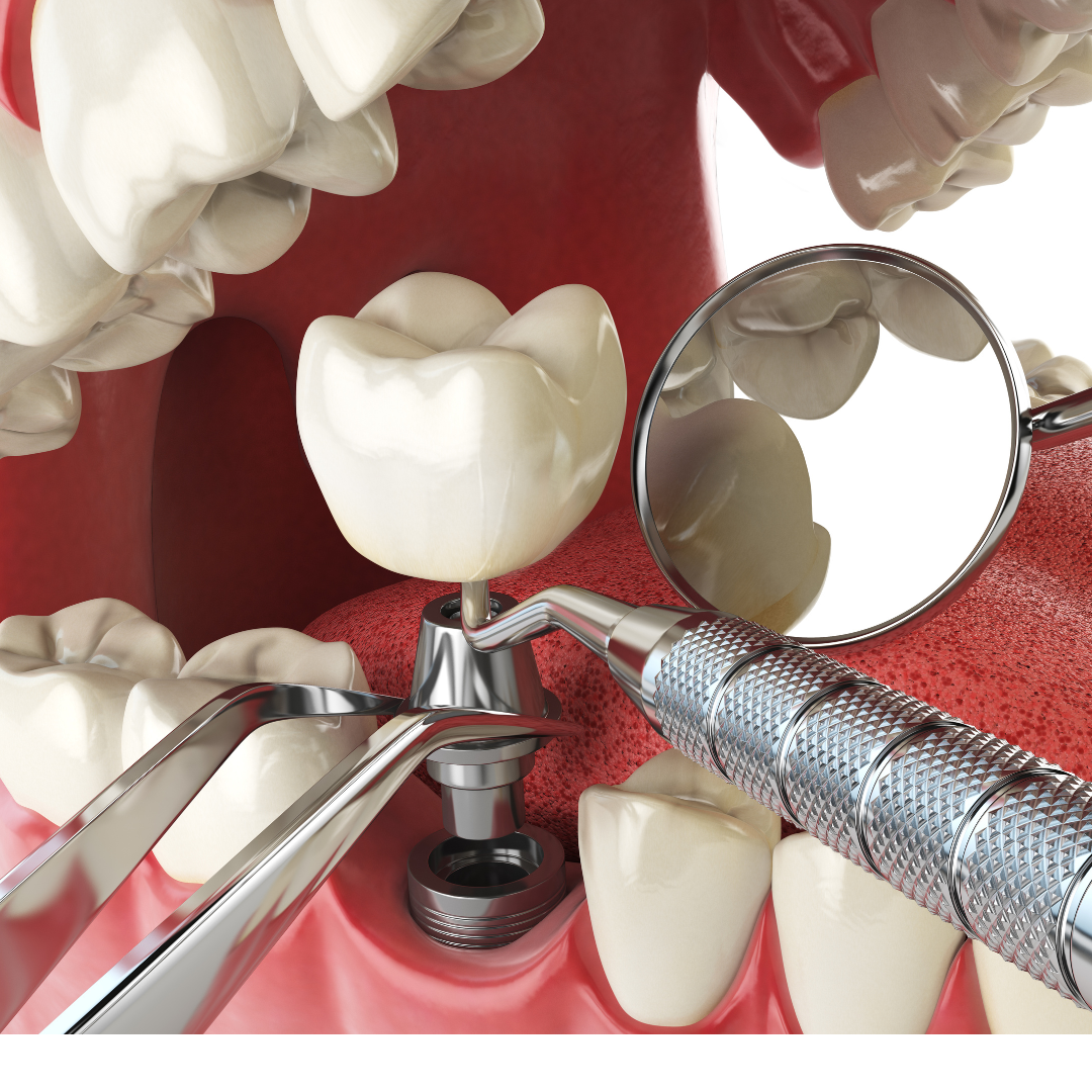 Dental Implants