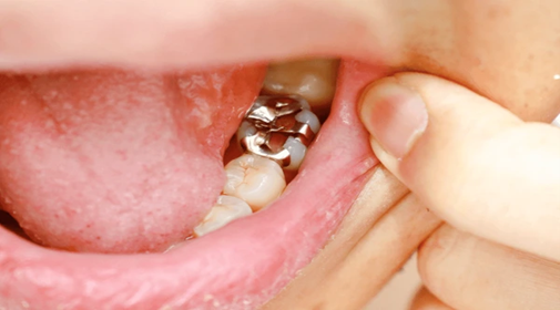 What is Dental Filling?