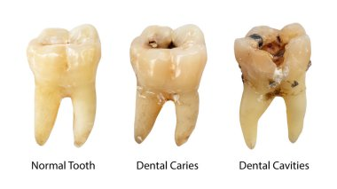 What is Dental Filling?