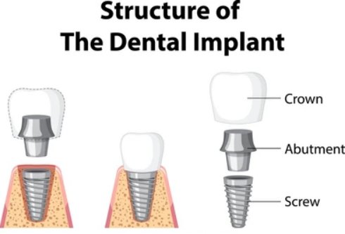 What are Dental Implants?