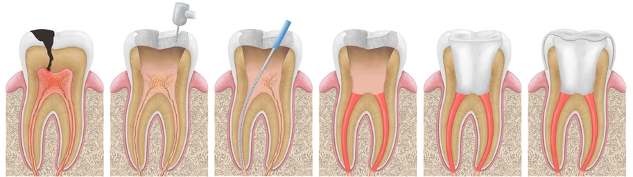 What is a Root Canal Treatment, and How Does It Work