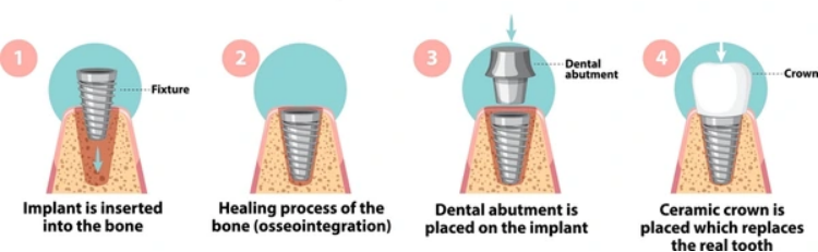 What is the Process of Dental Implants