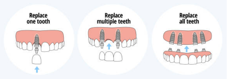 Why Are Dental Implants Required