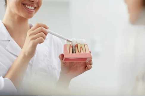 Advantages of Dental Implants