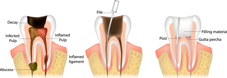 Dental Implants