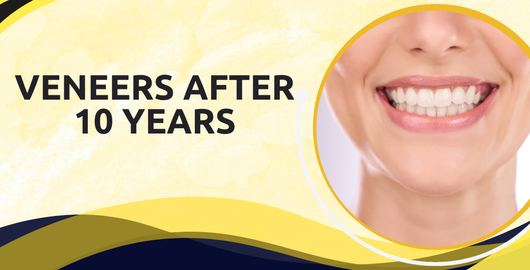 Introduction: Veneers After 10 Years