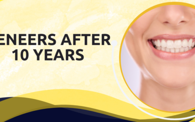 Veneers After 10 Years