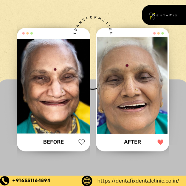 65 year old full mouth rehab Dental Implant in South Bopal