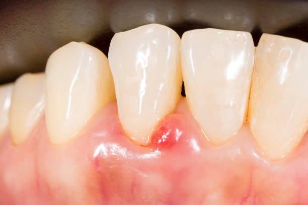 Gums Hurt During Pregnancy