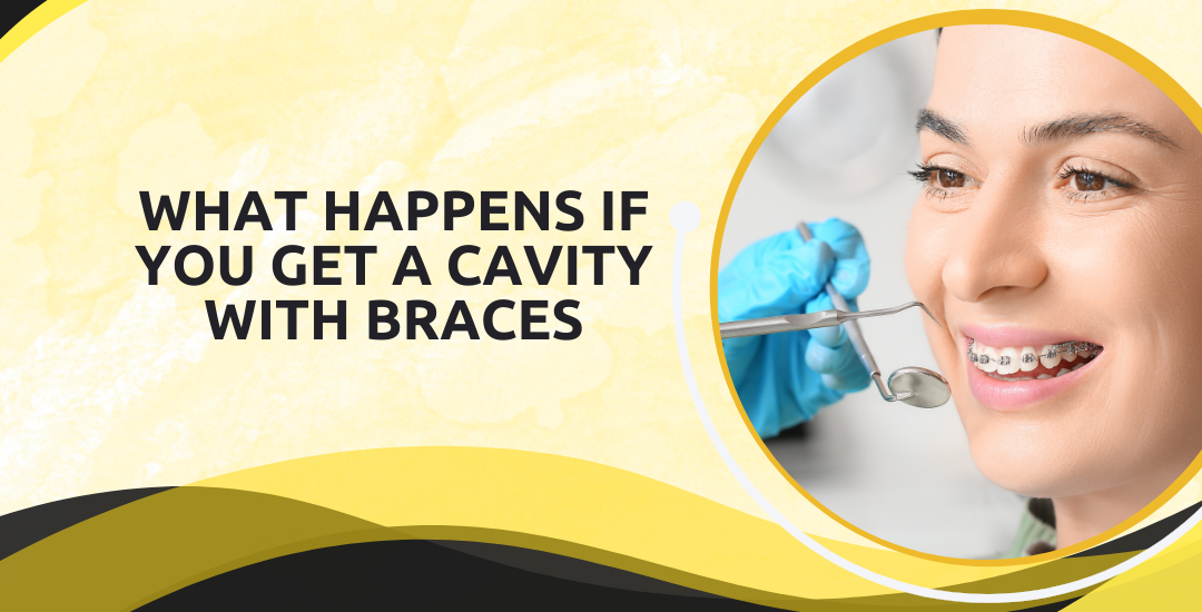 What Happens If You Get a Cavity with Braces?