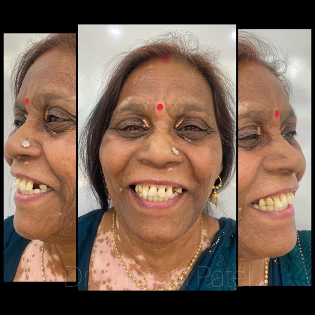 Dental Implant in South Bopal
