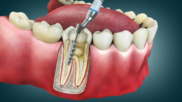 Preventing Prolonged Swelling