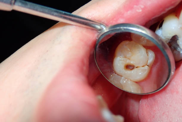 Causes of Swollen Cheek 3 Weeks After Wisdom Teeth Removal