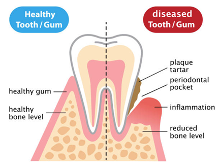 Why Are Dental Implants Required