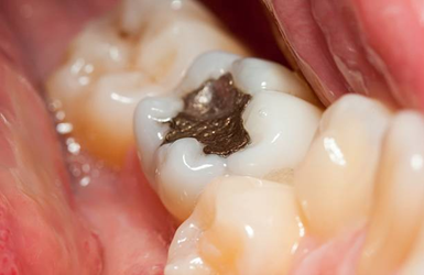 Teeth-Fillings