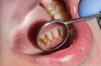 Advantages of Dental Implants