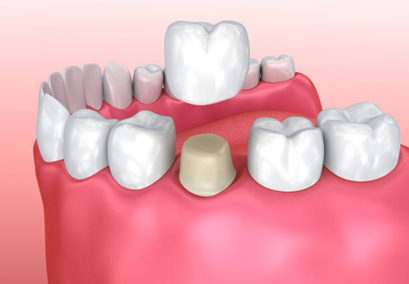 Preventing Prolonged Swelling