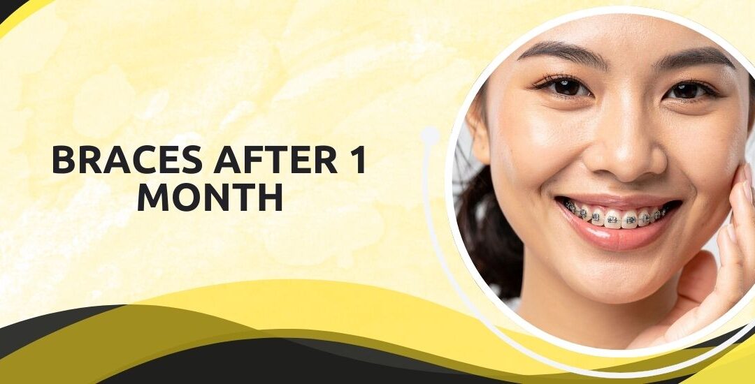 Braces Results After 1 Month: What to Expect